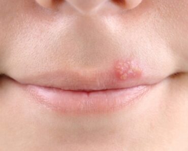 Conoce Cómo Quitar Herpes Labial: Medicamentos y Prevención