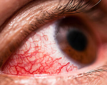 Aprende Cómo Quitar Ojos Rojos Naturalmente