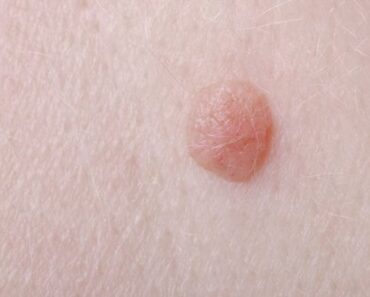 Cómo Quitar Verrugas Del Cuello con 5 Remedios